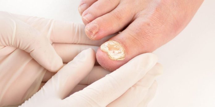 Madison ingrown toenail doctor